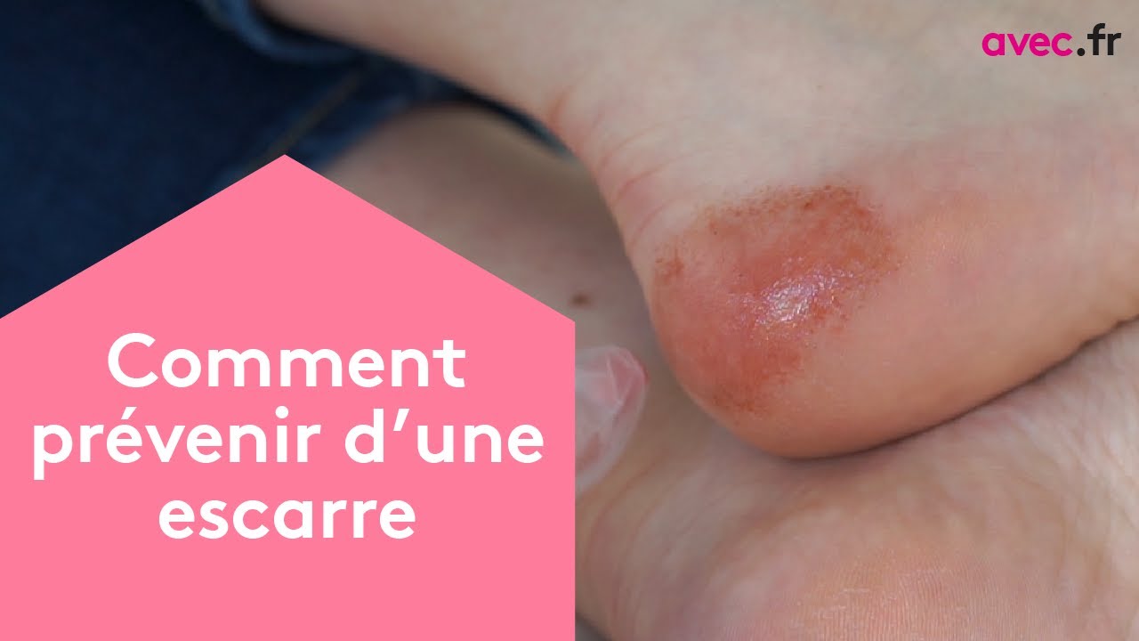 Escarre au stade 2 sur un talon avec perte cutanée partielle
